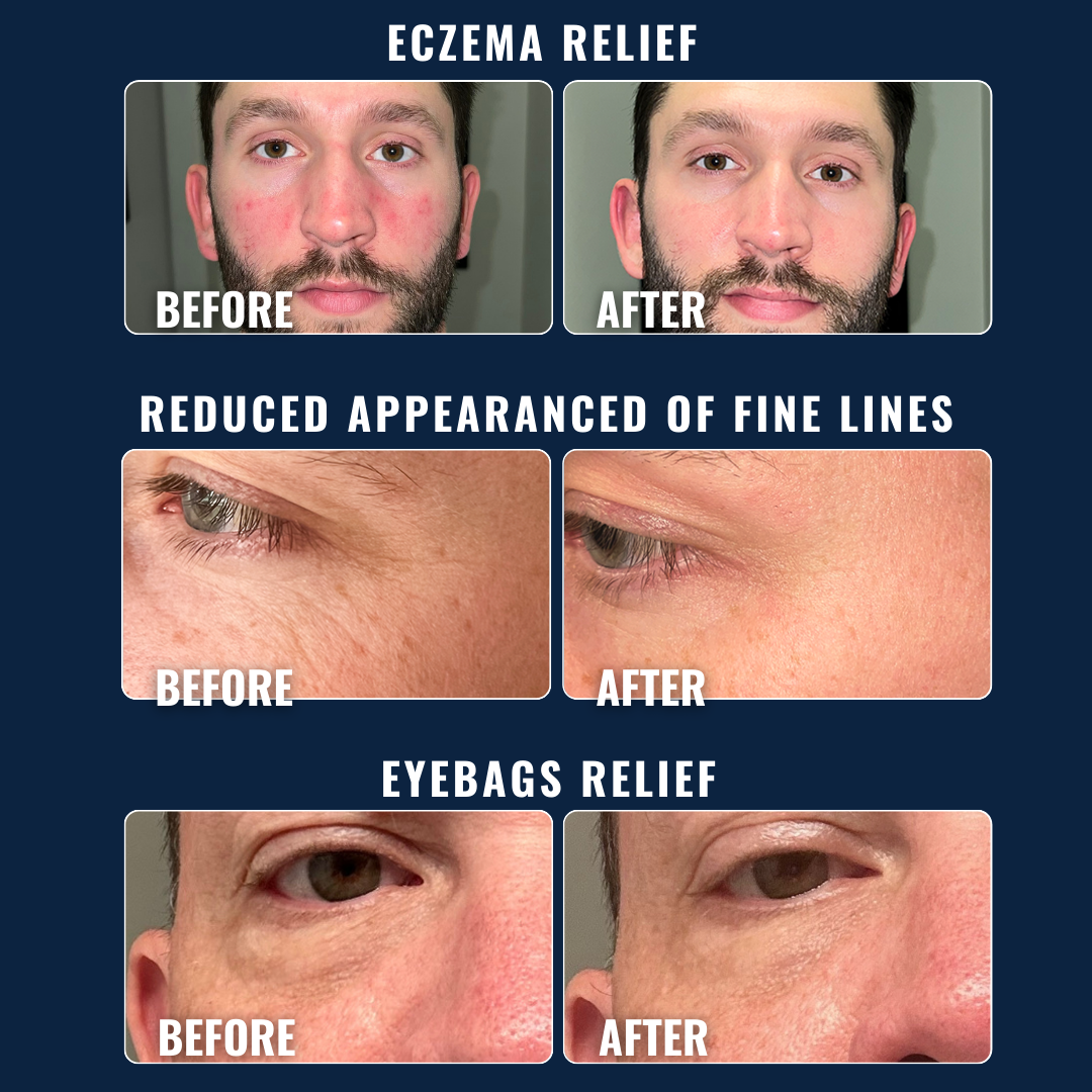 Moisturizer gives eczaema and eyebag relief + redues appearance of fine lines