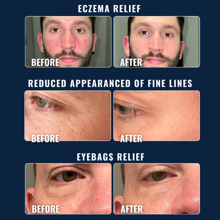 Moisturizer gives eczaema and eyebag relief + redues appearance of fine lines