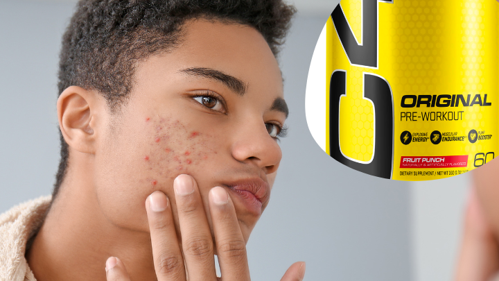 Young man touching acne on cheek with partial yellow pre-workout supplement container labeled 'Original Pre-Workout'