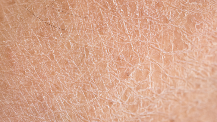 close-up of dry, flaky skin texture with visible fine lines and hair