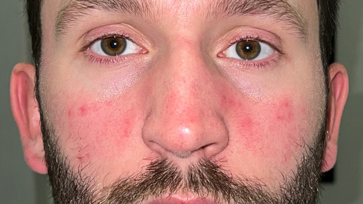 Close-up of a man's face showing redness on nose and cheeks