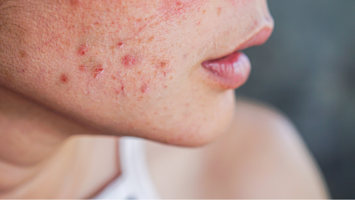 Close-up of a person's cheek showing red acne blemishes and inflamed skin.