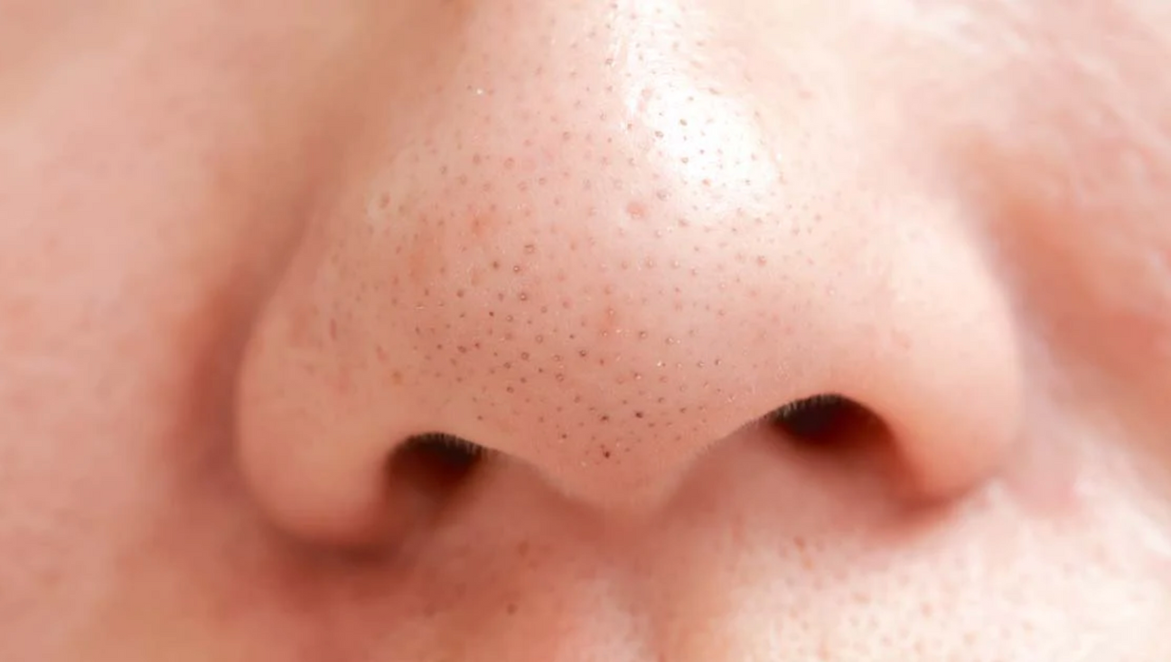 Close-up of a nose showing visible pores and blackheads on the skin surface