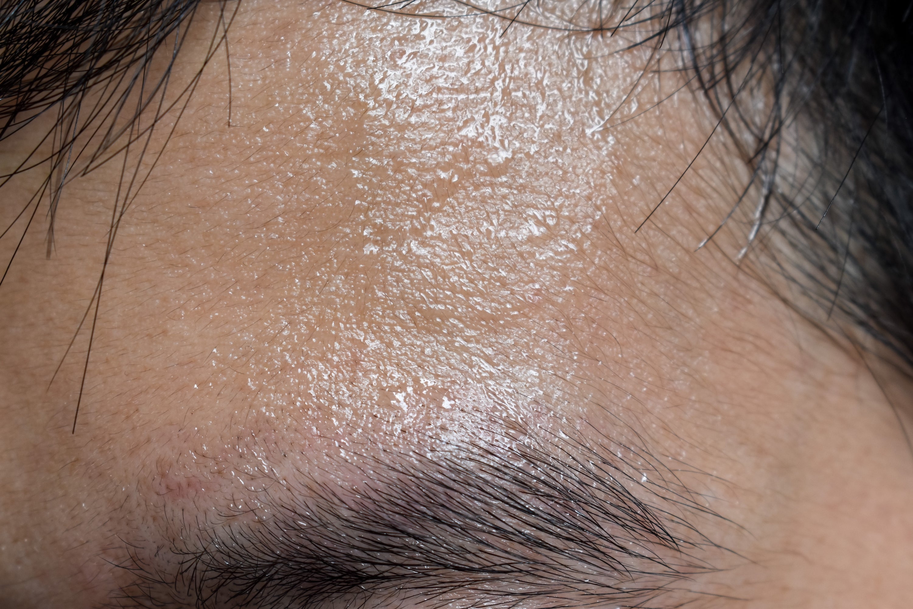 Close-up of oily skin on a forehead with visible pores and hair strands.