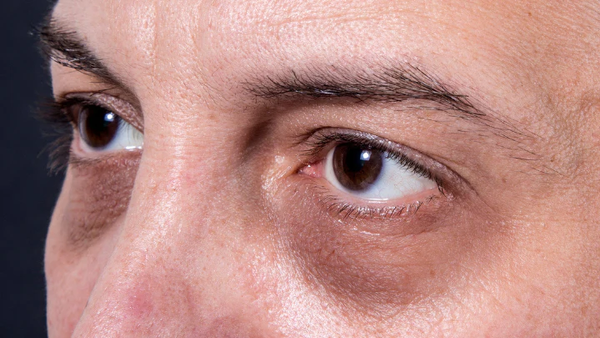 5 Reasons Guys Get Bags Under Their Eyes (and How to Get Rid of Them)