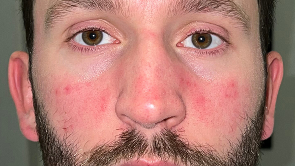 Got a Red Nose? Here are 8 Common Causes (and How to Treat Them)