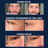 Moisturizer gives eczaema and eyebag relief + redues appearance of fine lines