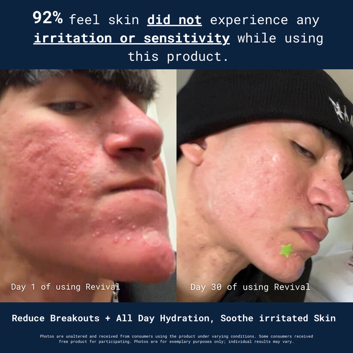 Side-by-side close-ups of a young man's cheek: Day 1 with red, peeling acne; Day 30 with reduced blemishes and smoother skin.